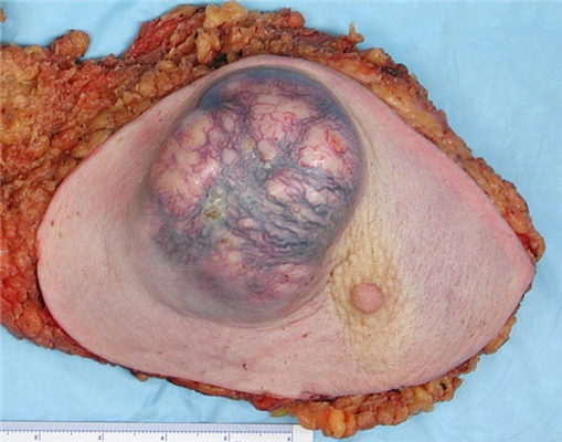 breast tumors and parotid tumors connection Bare backers nudist club